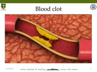 12/14/2017 8
Blood clot
 