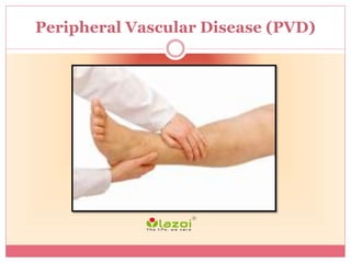 Peripheral Vascular Disease (PVD)
 