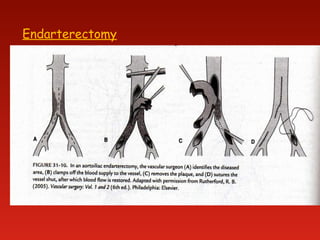 Endarterectomy
 