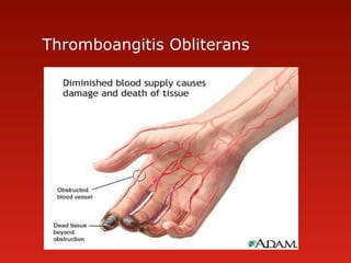 Thromboangitis Obliterans
 