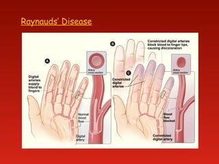 Raynauds’ Disease
 