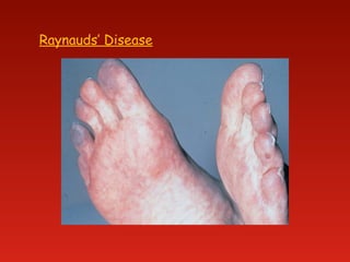 Raynauds’ Disease
 