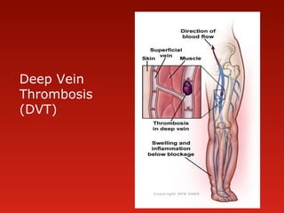 Deep Vein
Thrombosis
(DVT)
 