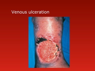 Venous ulceration
 