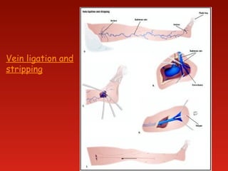 Vein ligation and
stripping
 
