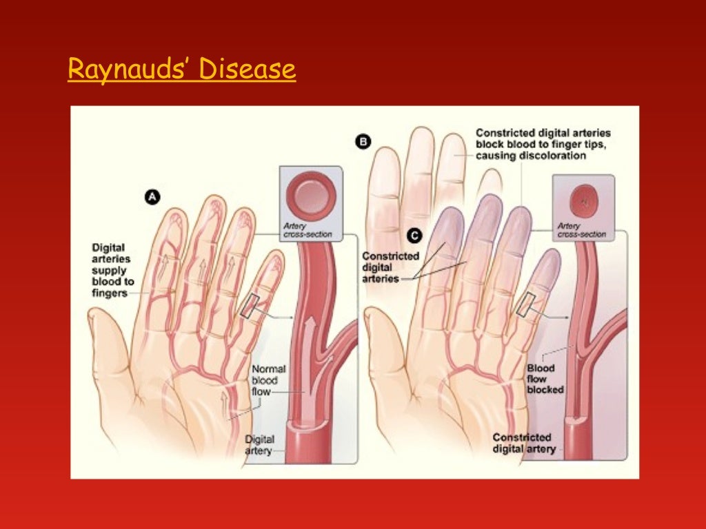 Peripheral vascular diseases