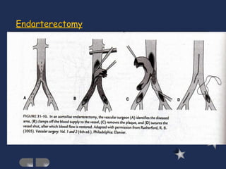 Endarterectomy 