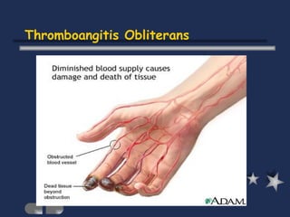 Thromboangitis Obliterans 