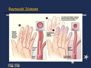 Raynauds’ Disease 