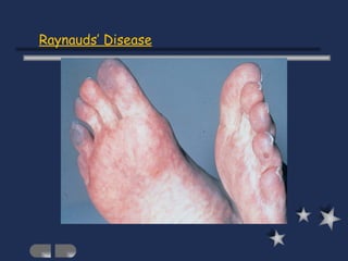 Raynauds’ Disease 