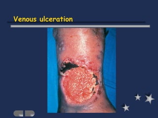 Venous ulceration 