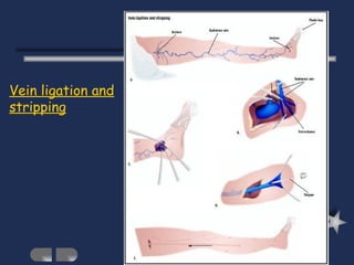 Vein ligation and stripping 