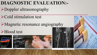 Cold Simulation Test Positive Peripheral vascular disorder.pdf