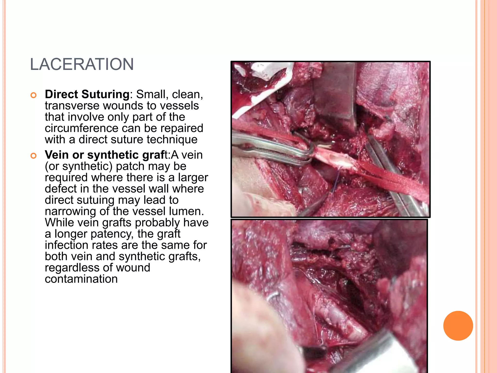 Peripheral Vascular Injuries | PPTX