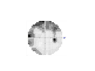 Peripheral visual field | PPTX