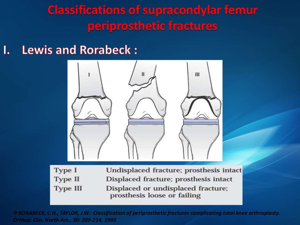 Periprosthetic fractures around the knee