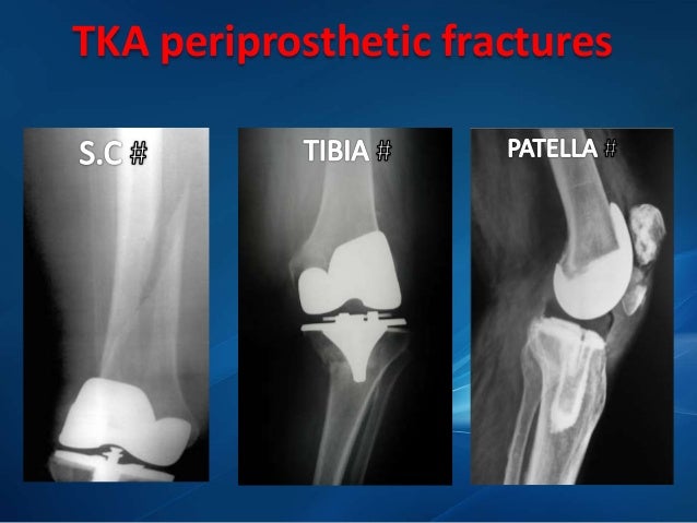 Periprosthetic Fractures Around The Knee Periprosthetic Fractures Around The Knee