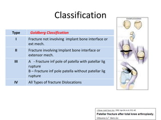 Classification
Type Goldberg Classification
I Fracture not involving implant bone interface or
ext mech.
II Fracture involving Implant bone interface or
extensor mech.
III A - Fracture inf pole of patella with patellar lig
rupture
B – Fracture inf pole patella without patellar lig
rupture
IV All Types of fracture Dislocations
 