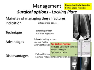 Management
Surgical options - Locking Plate
Mainstay of managing these fractures
Indication
Technique
Advantages
Disadvantages
Lateral approach
Anterior approach
Polyaxial locking screws
Internal fixator
Bicortical fixation
Pull out from osteoporotic bone
Fracture reduced independent of plate – mal-aligned
Osteoporotic bones
Biomechanically Superior
Better Distal Fixation
Far Cortical Fixation
Reduced Construct stiffness
Retain strength
Symmetric callus
Bottlang et JBJS 2010
 