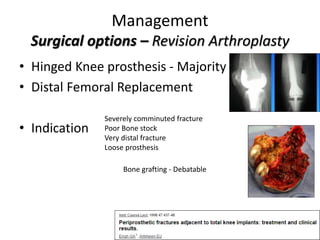 Management
Surgical options – Revision Arthroplasty
• Hinged Knee prosthesis - Majority
• Distal Femoral Replacement
• Indication
Severely comminuted fracture
Poor Bone stock
Very distal fracture
Loose prosthesis
Bone grafting - Debatable
 