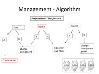 Management - Algorithm
Periprosthetic Tibial fracture
Type I Type II Type III
A B
B A A B
Conservative
Change
Component
ORIF/CRIF
Lock Plate
Change
Component
+ORIF
 