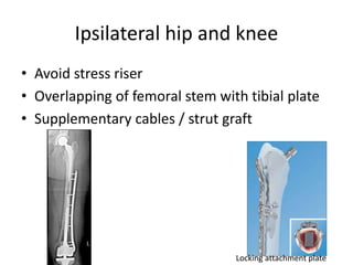 Ipsilateral hip and knee
• Avoid stress riser
• Overlapping of femoral stem with tibial plate
• Supplementary cables / strut graft
Locking attachment plate
 
