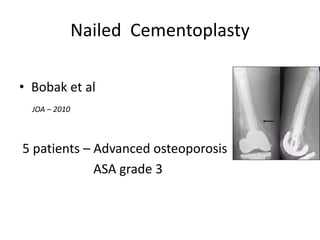 Nailed Cementoplasty
• Bobak et al
JOA – 2010
5 patients – Advanced osteoporosis
ASA grade 3
 