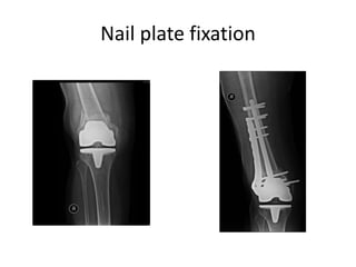 Nail plate fixation
 