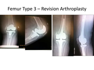 Femur Type 3 – Revision Arthroplasty
 