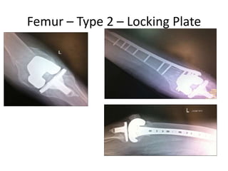 Femur – Type 2 – Locking Plate
 