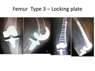 Femur Type 3 – Locking plate
 