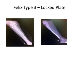 Felix Type 3 – Locked Plate
 