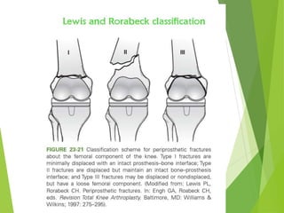 Peri prosthetic fracture | PPTX
