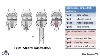 Periprosthetic_Knee_Fractures[1].pptx a break in the femur (thigh bone ...