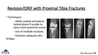 Periprosthetic_Knee_Fractures[1].pptx a break in the femur (thigh bone ...