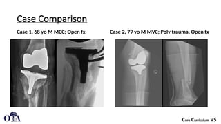 Periprosthetic_Knee_Fractures[1].pptx a break in the femur (thigh bone ...