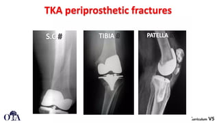 Periprosthetic_Knee_Fractures[1].pptx a break in the femur (thigh bone ...