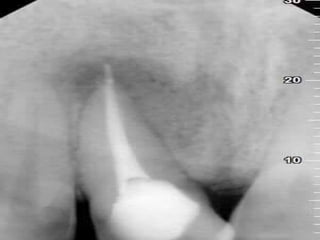 Periradicular lesions (1)