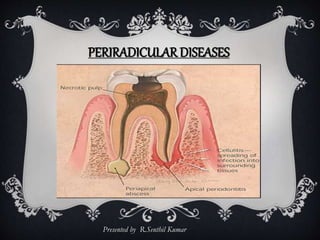 Presented by R.Senthil Kumar
PERIRADICULAR DISEASES
 