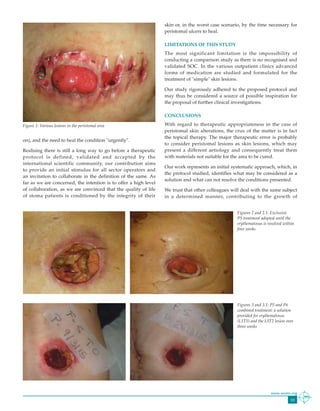 33
www.wcetn.org
Figure 1: Various lesions in the peristomal area
Figures 2 and 2.1: Exclusive P5 treatment adopted until the erythematosus is resolved within 4 weeks
Figures 3 and 3.1: P5 and P6 combined treatment: a solution provided for erythematosus (L1T5) and the L3T2 lesion over 3 weeks
Figure 1: Various lesions in the peristomal area
Figures 2 and 2.1: Exclusive P5 treatment adopted until the erythematosus is resolved within 4 weeks
Figures 3 and 3.1: P5 and P6 combined treatment: a solution provided for erythematosus (L1T5) and the L3T2 lesion over 3 weeks
Figures 2 and 2.1: Exclusive P5 treatment adopted until the erythematosus is resolved within 4 weeks
Figures 3 and 3.1: P5 and P6 combined treatment: a solution provided for erythematosus (L1T5) and the L3T2 lesion over 3 weeks
Figures 2 and 2.1: Exclusive
P5 treatment adopted until the
erythematosus is resolved within
four weeks
Fig. 4, 4.1, 4.2 Lesion L5. Treatment P6. Lesion cured after 5 weeks of treatment, effecting two changes each week.Fig. 4, 4.1, 4.2 Lesion L5. Treatment P6. Lesion cured after 5 weeks of treatment, effecting two changes each week.
Figures 3 and 3.1: P5 and P6
combined treatment: a solution
provided for erythematosus
(L1T5) and the L3T2 lesion over
three weeks
on), and the need to heal the condition "urgently".
Realising there is still a long way to go before a therapeutic
protocol is defined, validated and accepted by the
international scientific community, our contribution aims
to provide an initial stimulus for all sector operators and
an invitation to collaborate in the definition of the same. As
far as we are concerned, the intention is to offer a high level
of collaboration, as we are convinced that the quality of life
of stoma patients is conditioned by the integrity of their
skin or, in the worst case scenario, by the time necessary for
peristomal ulcers to heal.
LIMITATIONS OF THIS STUDY
The most significant limitation is the impossibility of
conducting a comparison study as there is no recognised and
validated SOC. In the various outpatient clinics advanced
forms of medication are studied and formulated for the
treatment of "simple" skin lesions.
Our study rigorously adhered to the proposed protocol and
may thus be considered a source of possible inspiration for
the proposal of further clinical investigations.
CONCLUSIONS
With regard to therapeutic appropriateness in the case of
peristomal skin alterations, the crux of the matter is in fact
the topical therapy. The major therapeutic error is probably
to consider peristomal lesions as skin lesions, which may
present a different aetiology and consequently treat them
with materials not suitable for the area to be cured.
Our work represents an initial systematic approach, which, in
the protocol studied, identifies what may be considered as a
solution and what can not resolve the conditions presented.
We trust that other colleagues will deal with the same subject
in a determined manner, contributing to the growth of
 