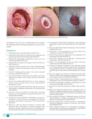 34
WCET Journal	 Volume 38 Number 1 – January/March 2018
knowledge. In our own case, we shall endeavour to maintain
the enthusiasm that to date has stimulated us to carry out our
studies.
REFERENCES
1.	 FAIS. Quanti siamo, 6 anni dopo. Ritrovarsi 2005; 15–16.
2.	 Rolstad BS & Erwin-Toth PL. Peristomal skin complication and
management. Ostomy Wound Manage 2004; 50(9):68–77.
3.	 Rothstein MS. Dermatologic consideration of stoma care. J Am
Acad Dermatol 1986; 15(3):411–32.
4.	 Broadwell DC. Peristomal skin integrity. Nurs Clin North Am
1987; 22(2):321–32.
5.	 Herlufsen P, Olsen AG, Carlsen B et al. Study of peristomal skin
disorders in patients with permanent stomas. Br J Nurs 2006;
15:854–62.
6.	 Calwell J, Goldberg M & Carmel J. The state of standard
diversions. J WOCN 2001; 28(1):6–17.
7.	 Jemec GB & Nybaek H. Peristomal skin problems account for
more than one in three visits to ostomy nurses. Br J Nurs 2008;
159:1211–2.
8.	 Davis JS, Svavarsdottir MH, Pudlo M et al. Factors impairing
quality of life for people with an ostomy. Gastrointestinal
Nursing 2011; 9:14–18.
9.	 Lyon CC, Smith AJ, Griffiths CEM & Beck AM. The spectrum of
skin disorders in abdominal stoma patients. Br J Dermatol 2000;
143(6):1248–60.
10.	Lyon CC, Smith AJ, Griffiths CE & Beck MA. Peristomal
dermatoses: a novel indication for topical steroid lotions. J Am
Dermatol 2000; 43:679–82.
11.	 Antonini M, Arena R, Militello G, Manfredda S, Gasperini S
& Veraldi S. A revised version of the original SACS Scale for
peristomal skin disorders classification. WCET Journal 2016;
36(3):20–29.
12.	Meisner S, Lehur PA, Moran B, Martins L & Jemec GBE.
Peristomal skin complications are common, expensive and
difficult to manage: a population-based cost modelling study.
PLoS ONE 2012; 7(5):e37813. doi: 10.1371/journal.pone.0037813.
13.	 Korzendorfer H, Scarborough P & Hettrick H. Tissue destruction
classification systems. Adv Skin Wound Care 2013; 26(11):499–
503.
14.	Alvey B & Beck DE. Peristomal dermatology. Clin Colon Rectal
Surg 2008; 21(1):41–44.
15.	Vojinovich A. The management of stoma-related skin
complications. Wounds UK 2006; 2(3):36–47.
16.	Woo KY. Peristomal skin complications and management. Adv
Skin Wound Care 2009; 22(11):522–32.
17.	Erwin-Toth P, Stricker LJ & van Rijswijk L. Peristomal skin
complications. AJN 2010; 110(2):43–48.
18.	Burch J. The management and care of people with stoma
complications. Br J Nurs 2004; 13(6):307–18.
19.	Charousaei F, Dabirian A & Mojab F. Using chamomile solution
or a 1% topical hydrocortisone ointment in the management
of peristomal skin lesions in colostomy patients: Results of a
controlled clinical study. Ostomy Wound Manage 2011; 57(5):28–
36.
20.	Lyon CC, Stapleton M, Smith AJ, Griffiths CE & Beck MH.
Topical sucralfate in the management of peristomal skin disease:
an open study. Clin Exp Dermatol 2000; 25(8):584–8.
21.	Fong J & Wood F. Nanocrystalline silver dressings in wound
management: a review. Int J Nanomedicine 2006 Dec; 1(4):441–9.
22.	Chen WYJ & Abatangelo G. Functions of hyaluronan in wound
repair. Wound Rep Regen 1999; 7(2):79–89.
23.	Laurent TC & Fraser JR. Hyaluronan. FASEB J 1002; 6(7):2397–
404.
24.	Ellis I, Grey AM, Schor AM & Schor SL. Antagonistic effects of
TGF-beta 1 and MSF on fibroblast migration and hyaluronic acid
synthesis. Possible implications for dermal wound healing. J Cell
Sci 1992; 102(Pt 3):447–56.
25.	Ellis I, Banyard J & Schor SL. Differential response of fetal and
adult fibroblasts to cytokines: cell migration and hyaluronan
synthesis. Development 1997; 124(8):1593–600.
26.	West DC, Hampson IN, Arnold F & Kumar S. Angiogenesis
induced by degradation products of hyaluronic acid. Science
1985; 228(4705):1324–6.
27.	Sattar A, Rooney P, Kumar S et al. Application of angiogenic
oligosaccharides of hyaluronan increases blood vessel numbers
in rat skin. J Invest Dermatol 1994; 103(4):576–9.
Figures 4, 4.1 and 4.2 Lesion L5, treatment P6. Lesion cured after five weeks of treatment, effecting two changes each week.
 