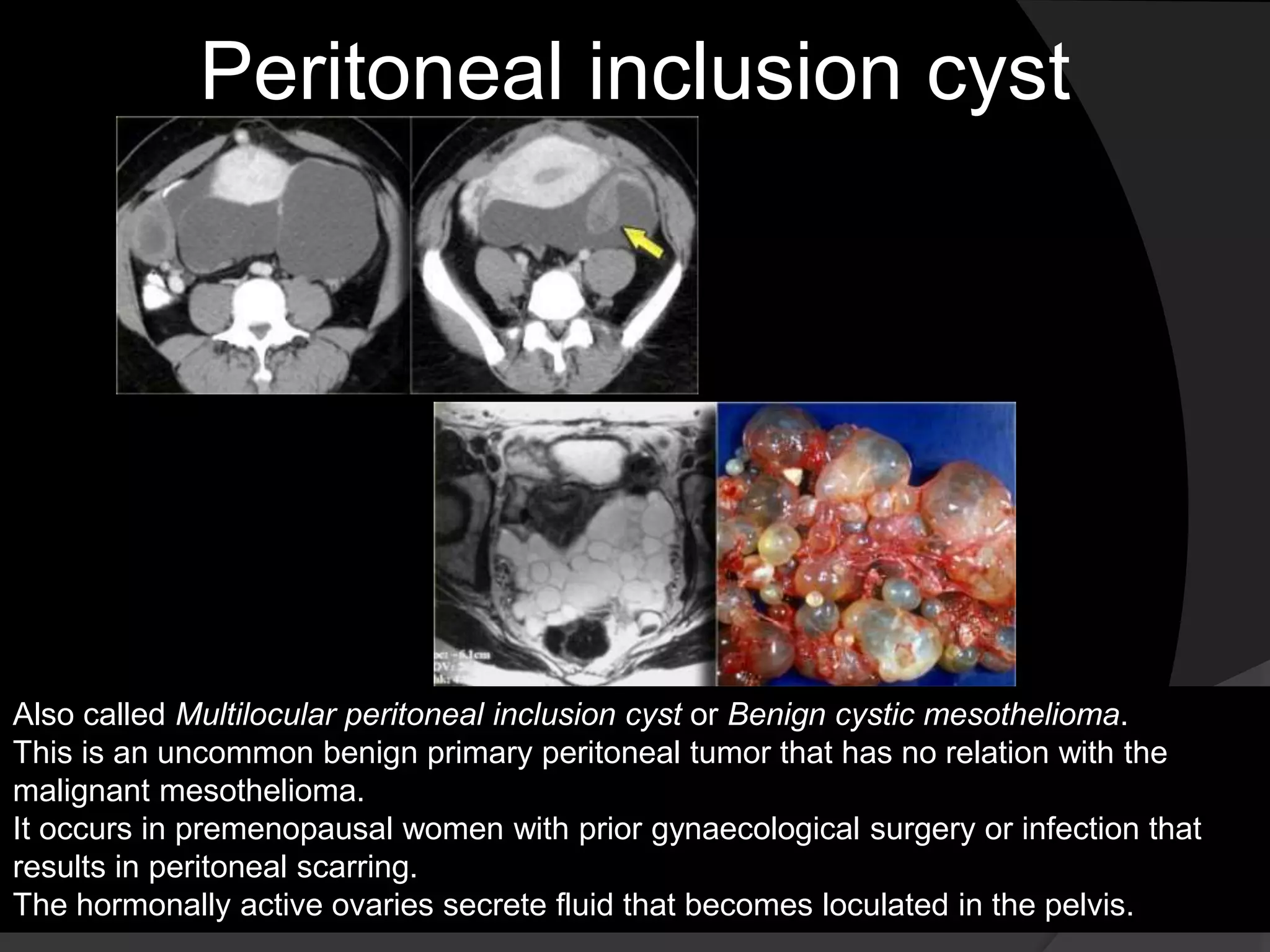 Peritoneal inclusion cyst
Also called Multilocular peritoneal inclusion cyst or Benign cystic mesothelioma.
This is an uncommon benign primary peritoneal tumor that has no relation with the
malignant mesothelioma.
It occurs in premenopausal women with prior gynaecological surgery or infection that
results in peritoneal scarring.
The hormonally active ovaries secrete fluid that becomes loculated in the pelvis.
 
