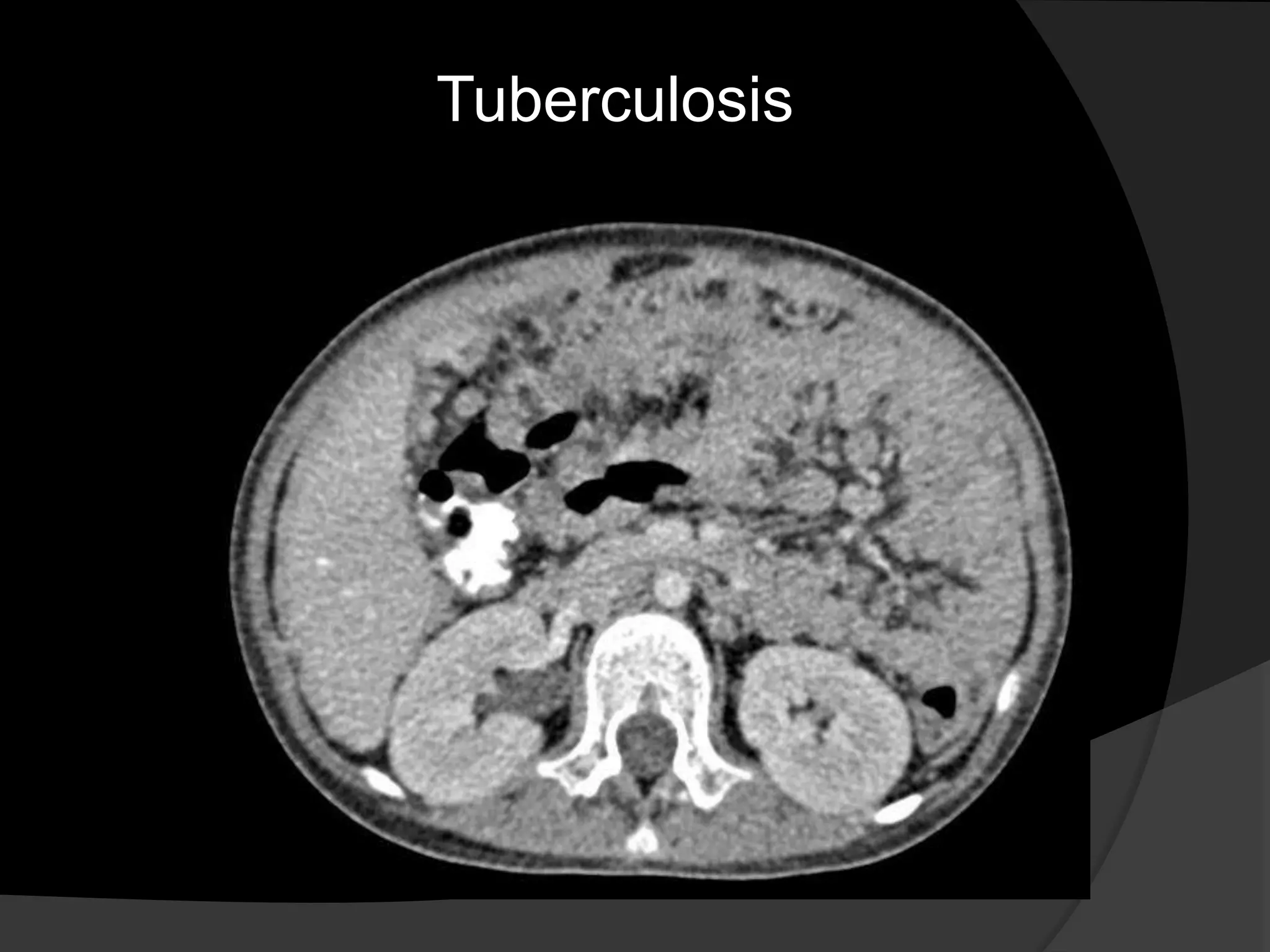Tuberculosis
 