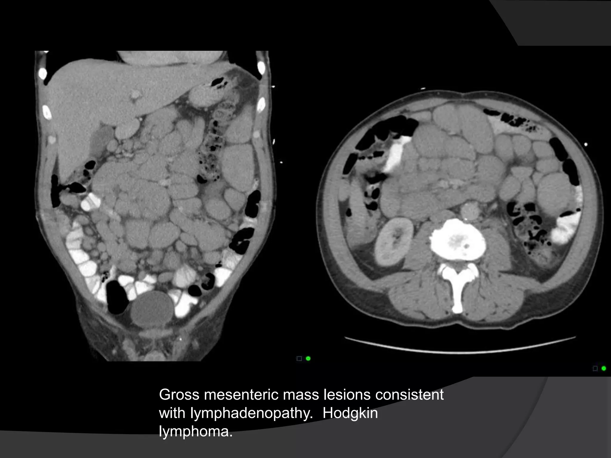 Gross mesenteric mass lesions consistent
with lymphadenopathy. Hodgkin
lymphoma.
 