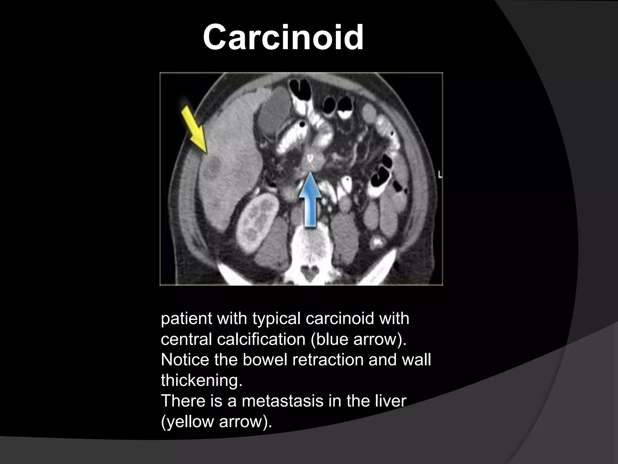 Carcinoid
patient with typical carcinoid with
central calcification (blue arrow).
Notice the bowel retraction and wall
thickening.
There is a metastasis in the liver
(yellow arrow).
 