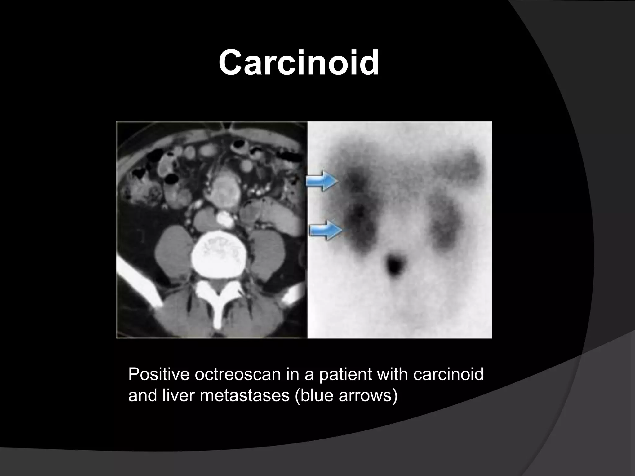 Positive octreoscan in a patient with carcinoid
and liver metastases (blue arrows)
Carcinoid
 