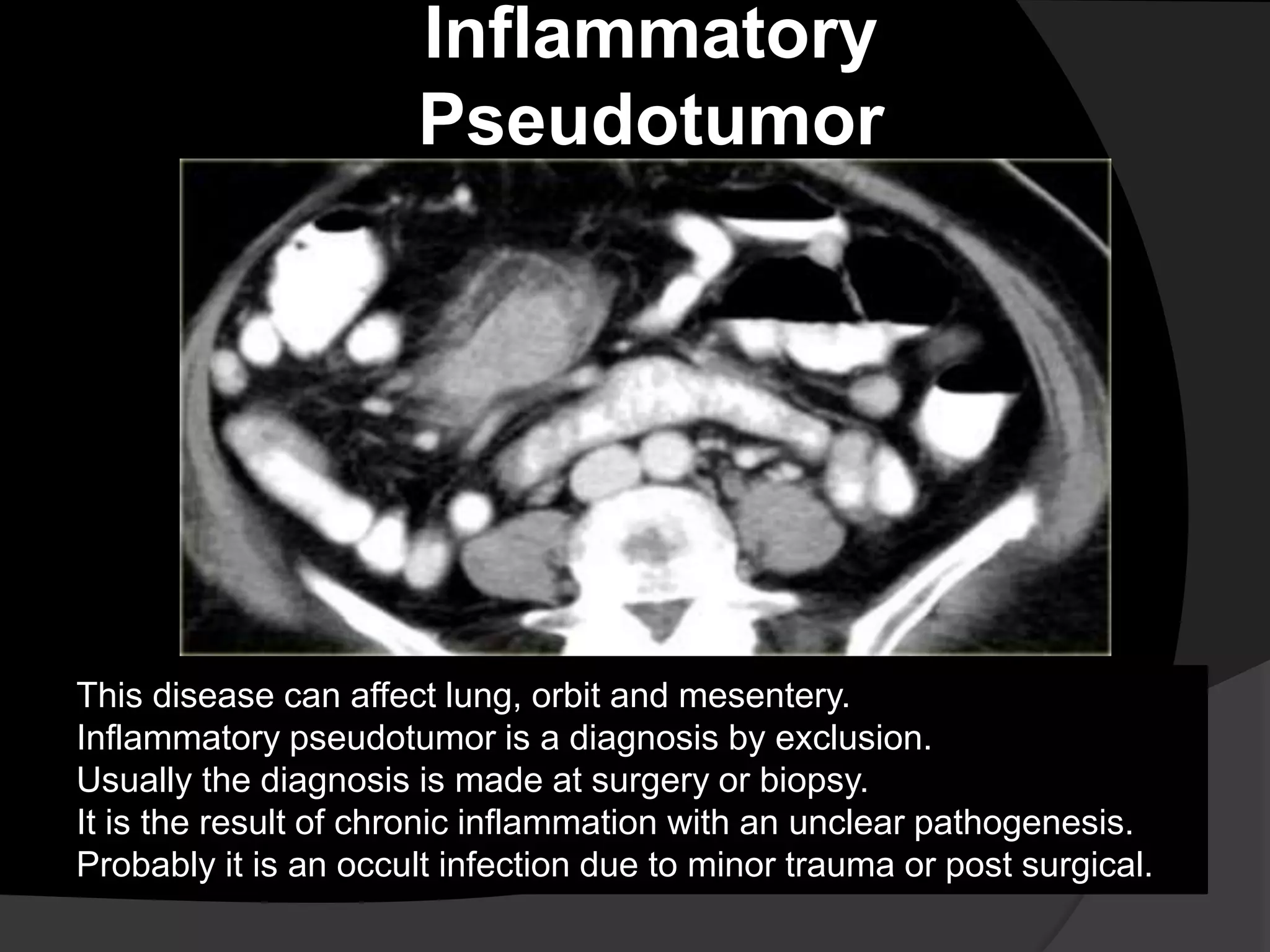 Inflammatory
Pseudotumor
This disease can affect lung, orbit and mesentery.
Inflammatory pseudotumor is a diagnosis by exclusion.
Usually the diagnosis is made at surgery or biopsy.
It is the result of chronic inflammation with an unclear pathogenesis.
Probably it is an occult infection due to minor trauma or post surgical.
 