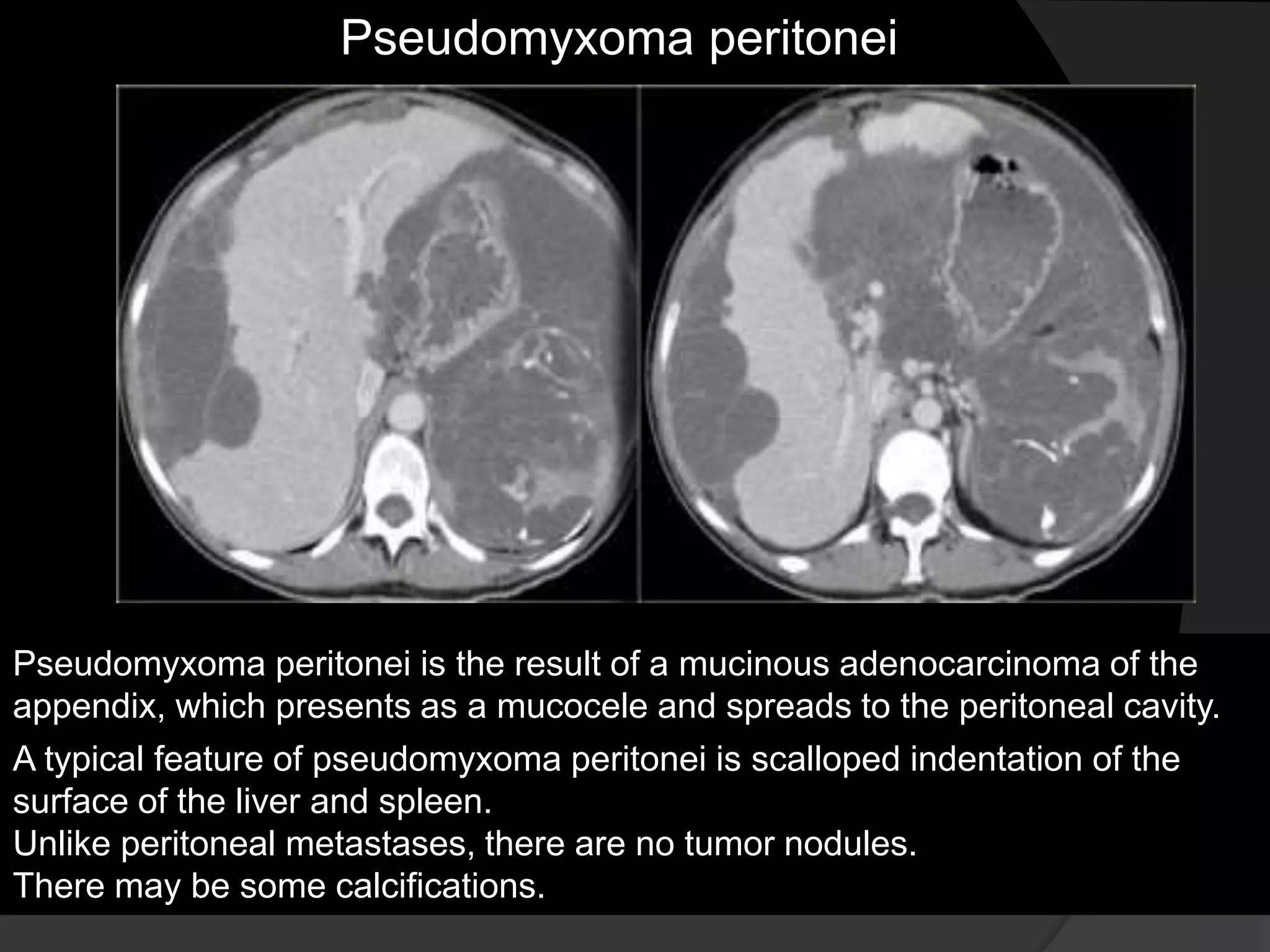 Pseudomyxoma peritonei
Pseudomyxoma peritonei is the result of a mucinous adenocarcinoma of the
appendix, which presents as a mucocele and spreads to the peritoneal cavity.
A typical feature of pseudomyxoma peritonei is scalloped indentation of the
surface of the liver and spleen.
Unlike peritoneal metastases, there are no tumor nodules.
There may be some calcifications.
 