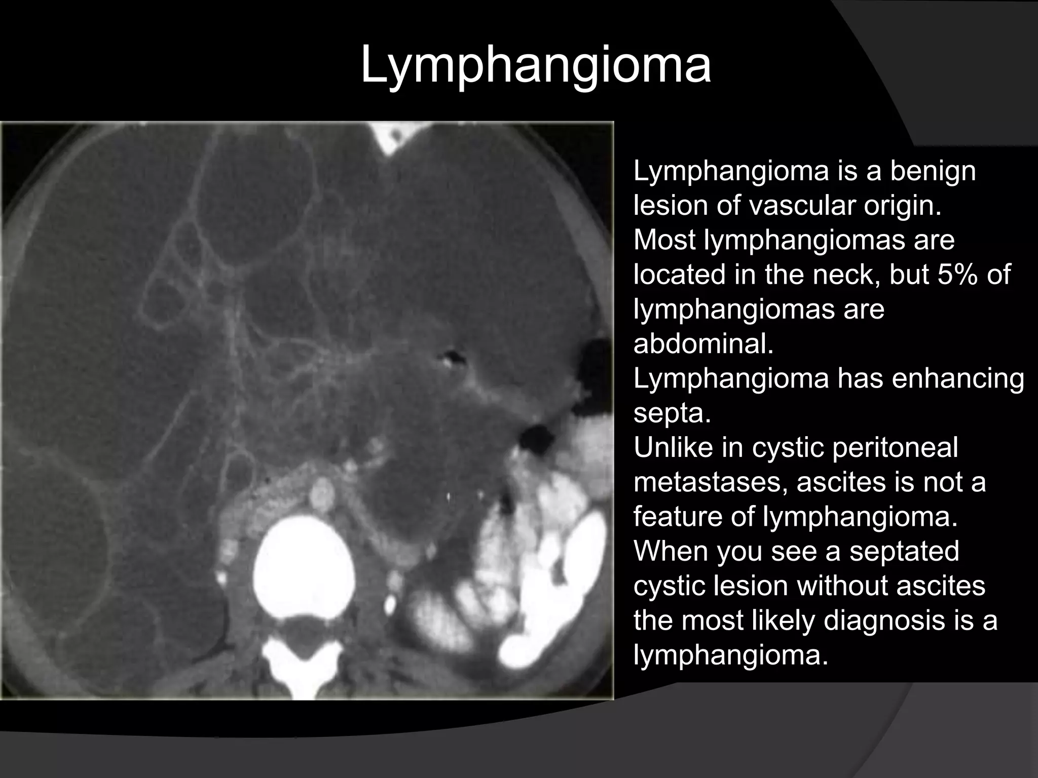 Lymphangioma
Lymphangioma is a benign
lesion of vascular origin.
Most lymphangiomas are
located in the neck, but 5% of
lymphangiomas are
abdominal.
Lymphangioma has enhancing
septa.
Unlike in cystic peritoneal
metastases, ascites is not a
feature of lymphangioma.
When you see a septated
cystic lesion without ascites
the most likely diagnosis is a
lymphangioma.
 