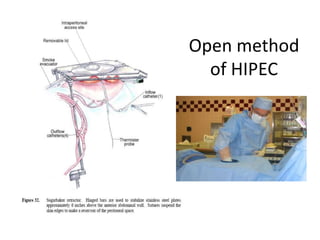 Open Hipec Peritoneal carcinomatosis | PPTX